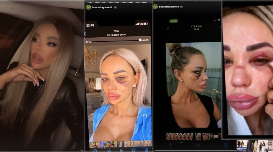 Bianca Drăguşanu a postat o poză cu ochii învinețiți
