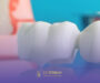 La ce prețuri ne așteptăm pentru coroane dentare în București? Clinica stomatologică Dr. Șerban